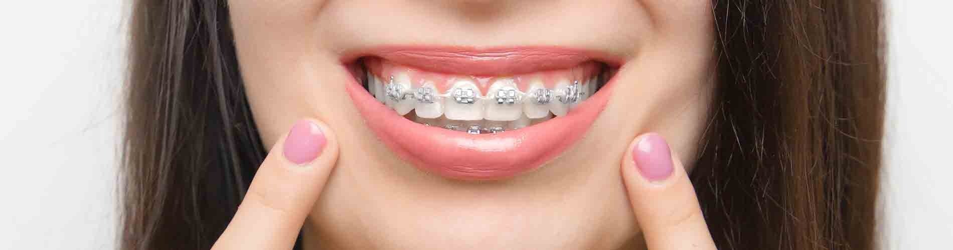 Consejos de higiene para personas con ortodoncia fija