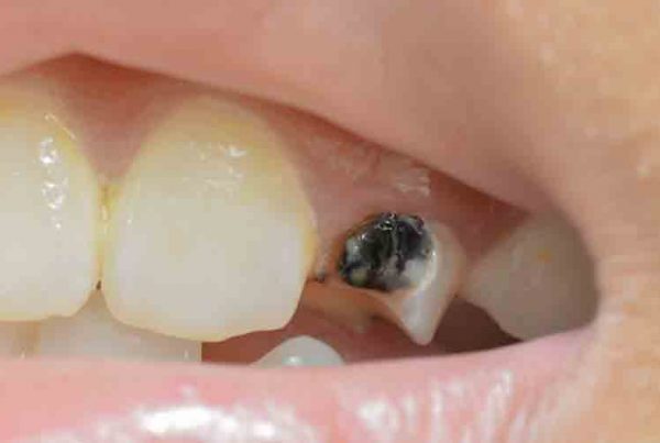 evitar las caries