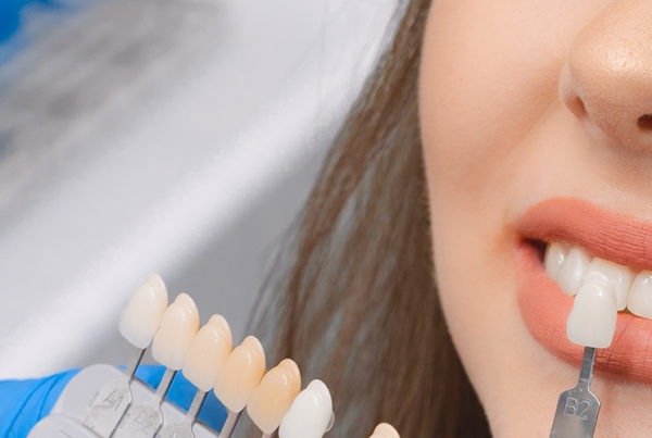 dientes de porcelana