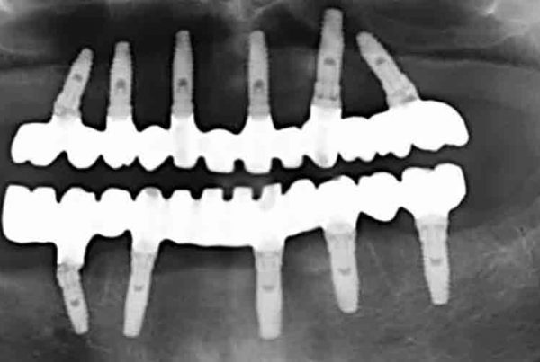 pérdida de dientes