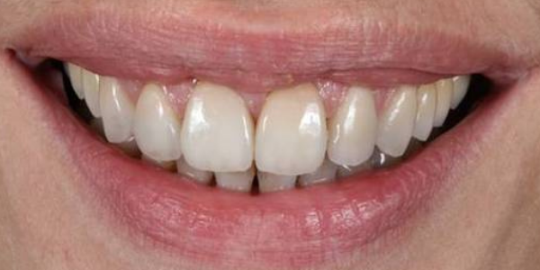 dientes separados y oscuros