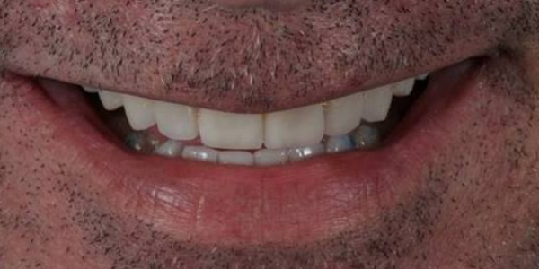 duele-mandibula-despues