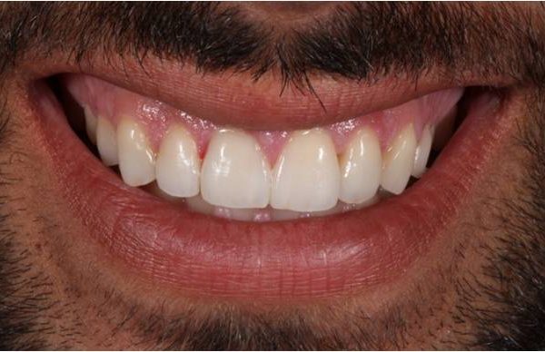 dientes sensibilidad halitosis