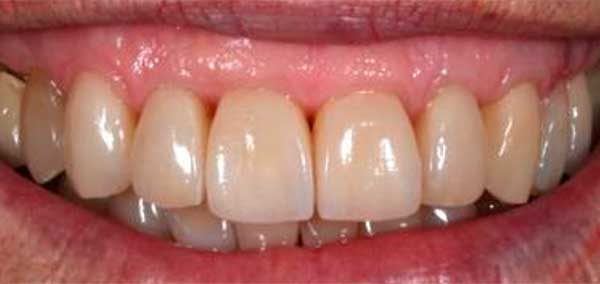 dientes largos con movilidad y espacios negros