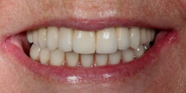 faltan-dientes-sonrisa-despues