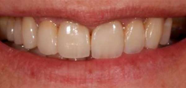 fondo sensibilidad dientes después sonrisa