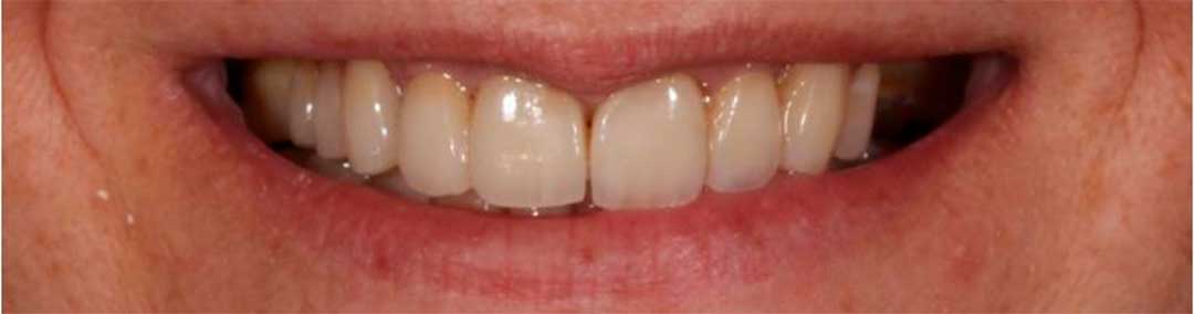 Mucha sensibilidad en los dientes