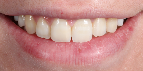 infeccion-diente-nervio-matado-sonrisa-despues