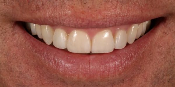 dientes-gastados-apretar-mandibula-despues