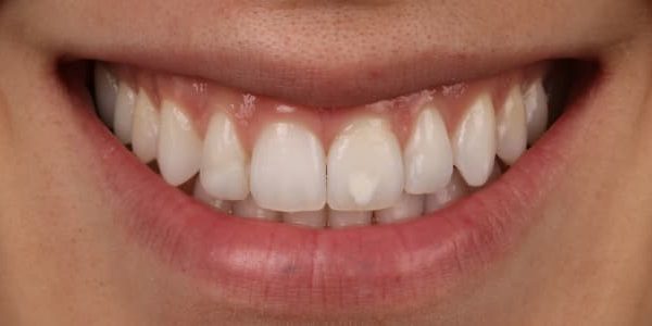 ortodoncia-invisible-dientes-blancos-despues