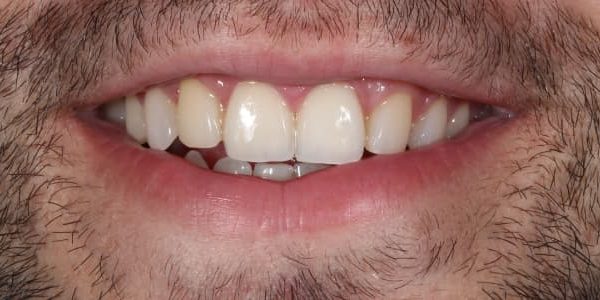 rotura-dientes-anterosuperiores-sonrisa-despues