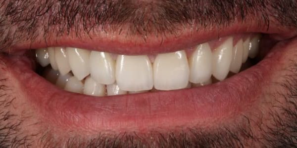 puente-metal-margen-metalico-sonrisa-despues
