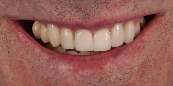 sangran-encias-sonrisa-despues