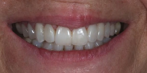 Dientes superiores salidos y oscuros