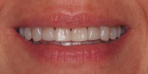 Encías retraídas y dientes oscuros