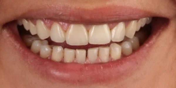 rotura-diente-anterior-sonrisa-despues