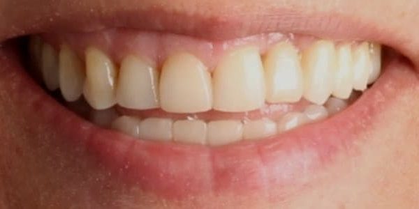 Dientes móviles y dificultad al comer