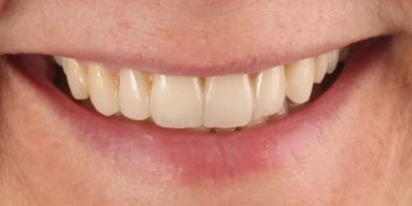 Dientes largos y con espacios