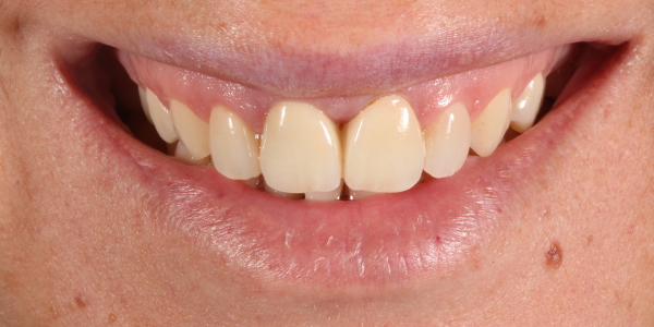 Metal visible de las fundas dentales
