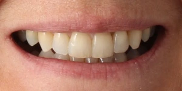 Dientes grandes y amarillos