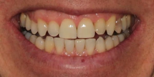 blanqueo de dientes