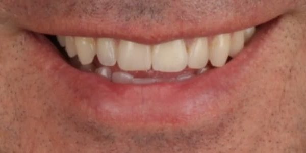 dientes amarillos