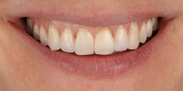 Dientes movidos después de la ortodoncia