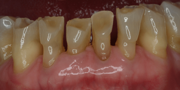 incisivos gastados y sensibilidad dental
