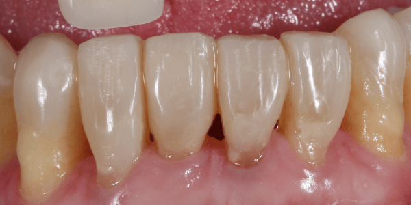 incisivos gastados y sensibilidad dental