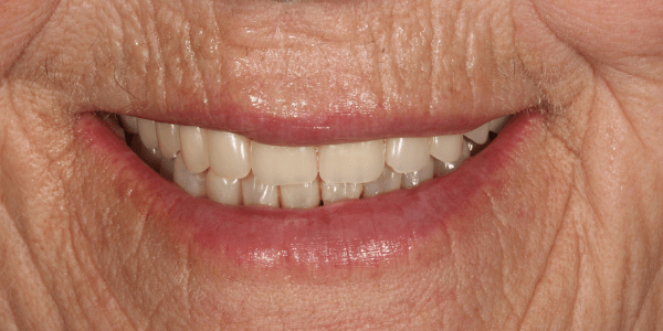 incisivos gastados y sensibilidad dental