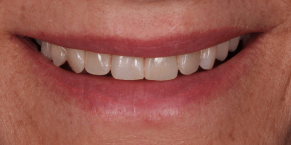 presupuesto dental limitado