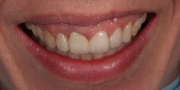 corona antigua más larga que mis dientes