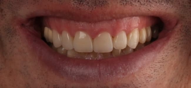 dientes pequeños y separados