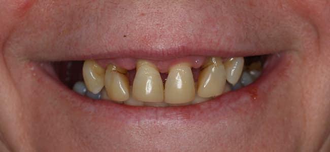 dientes sin implantes