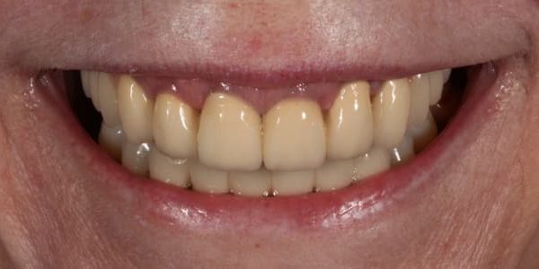 dientes sin implantes