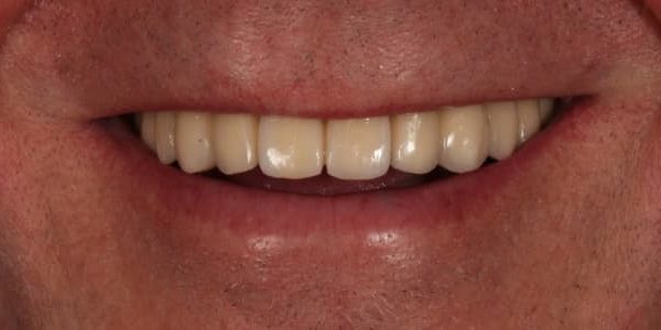 implantes dentales