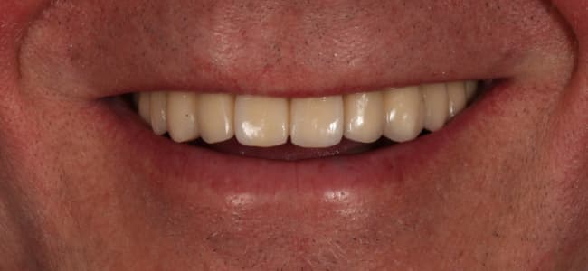 Implantes dentales a falta de dientes