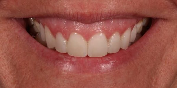 dientes y sonreír con naturalidad