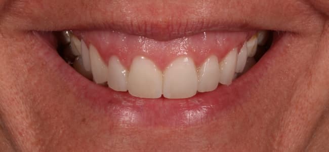 Mejorar estética de dientes y sonreír con naturalidad