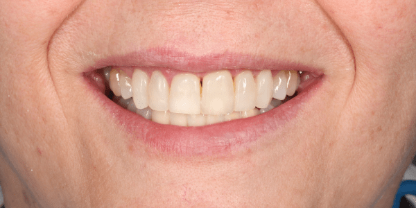coronas que dejan visibles los dientes