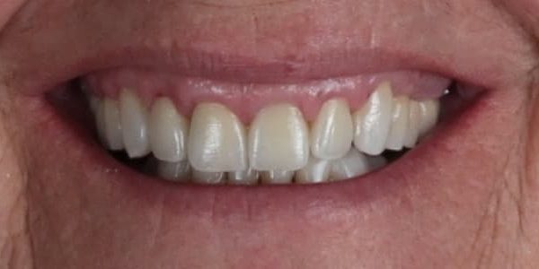 dientes que se mueven