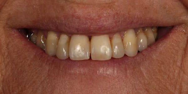 Dientes oscurecidos e incisivos laterales