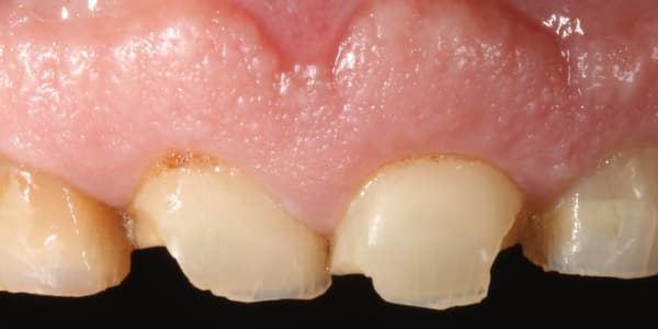 dientes desgastados