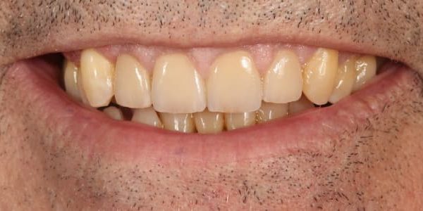 dientes desgastados