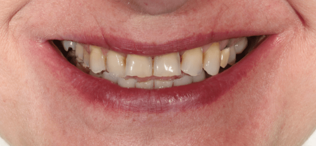 reconstrucción de dientes