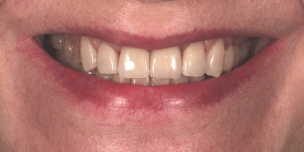 reconstrucción de dientes