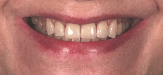Reconstrucción de dientes