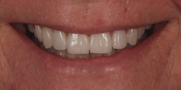 dientes desplazados