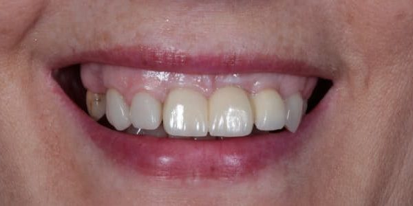 implantes antiestéticos