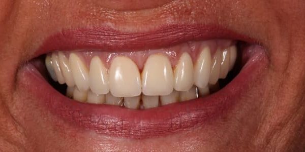 miedo a perder dientes